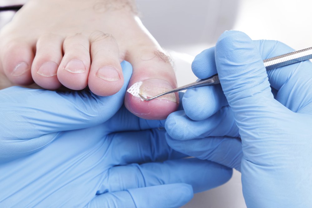 Ingrown Toenail